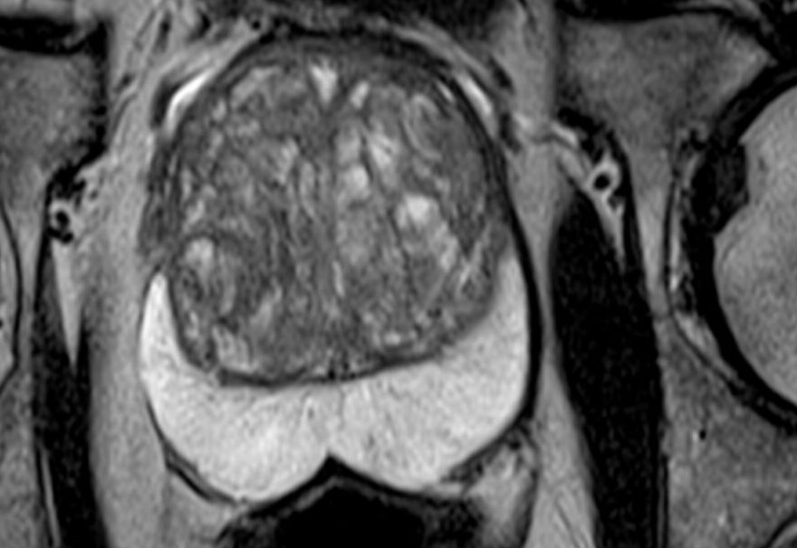 MRI of prostate cancer